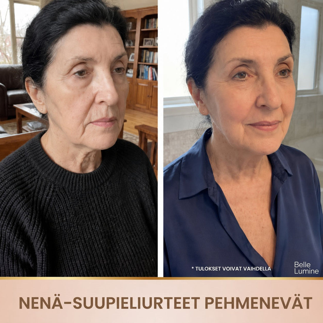 Antes e depois – sulcos nasogenianos suavizados