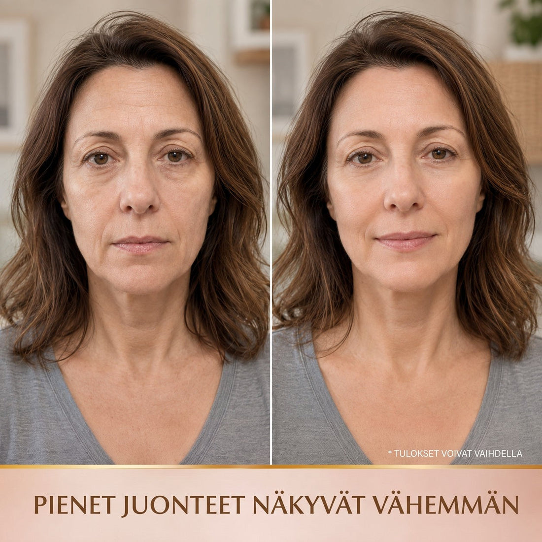 Antes e depois – linhas finas menos visíveis