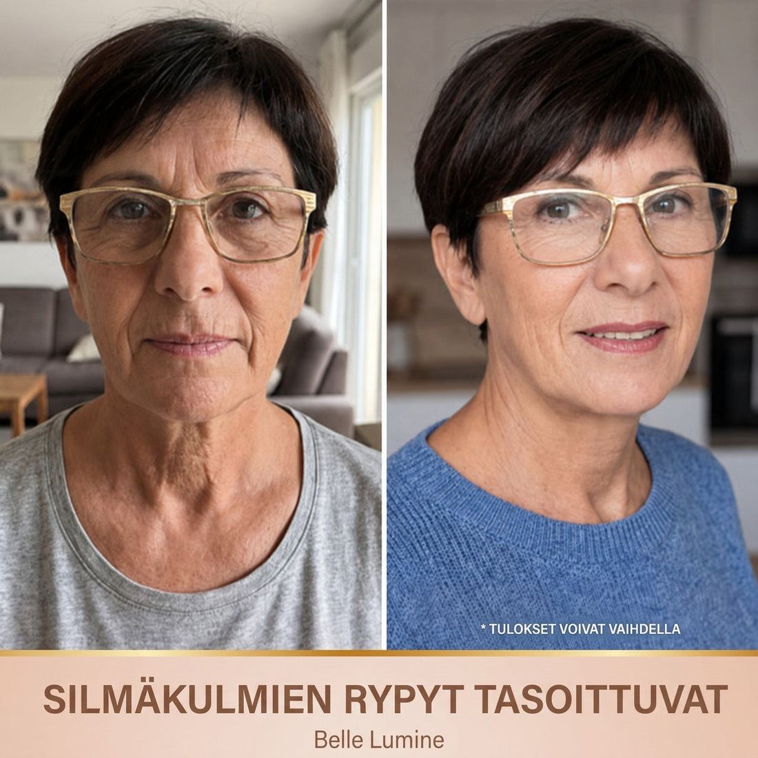 Antes e depois – pés de galinha suavizados